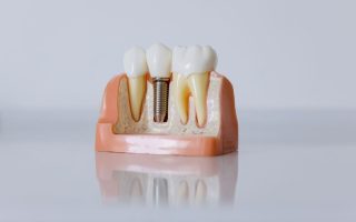 model implantu zębowego na białym tle