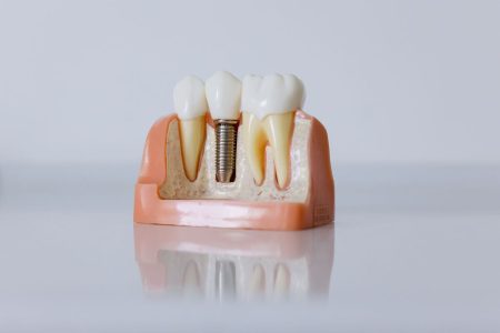 model implantu zębowego na białym tle